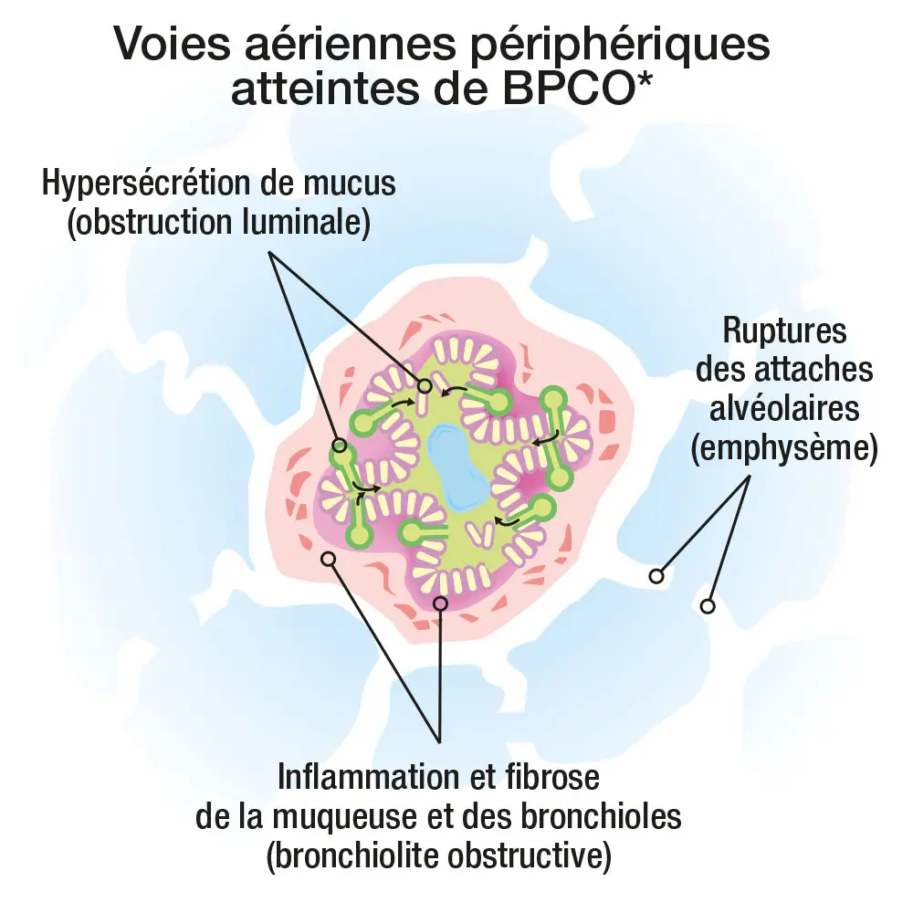 Illustration biologique cellulaire sur l'incidence de la BPCO